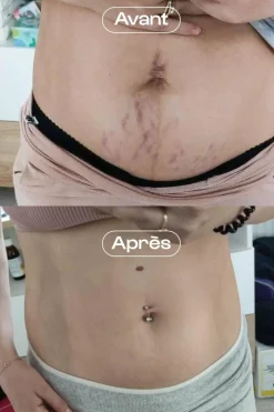 Concentré correcteur vergetures L’Expert